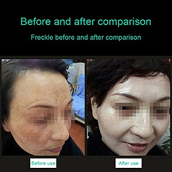 Acheter Wewoo stylo laser picoseconde visage