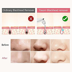 Chrono Extracteur de points noirs électrique pas cher